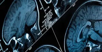 Más de 50 millones de personas padecen epilepsia en todo el mundo