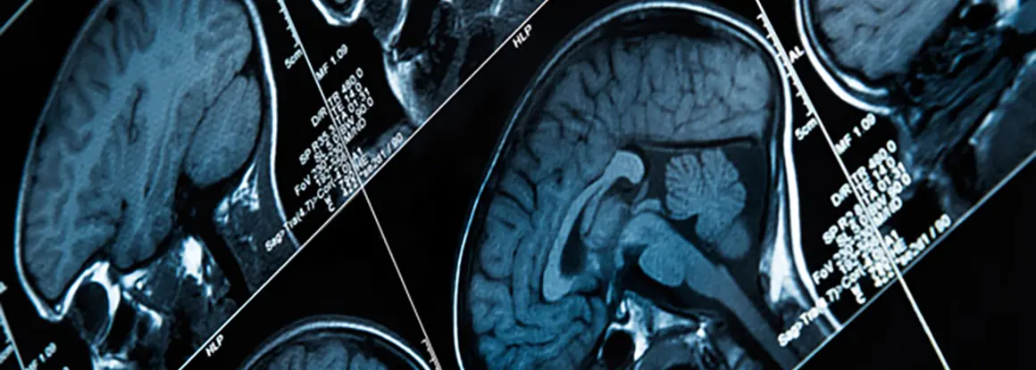 Más de 50 millones de personas padecen epilepsia en todo el mundo