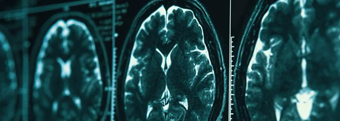 Un fármaco aún en investigación frena un 27% el deterioro cognitivo en personas con Alzheimer, según Eisai y Biogen