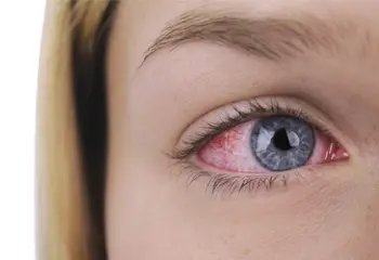 ¡Ojo con la conjuntivitis!