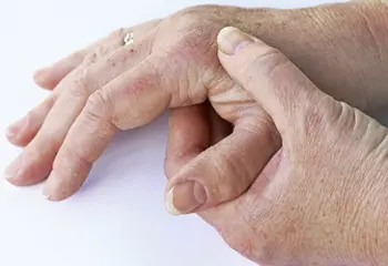 Rizartrosis o artrosis del pulgar