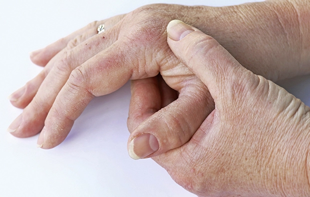 Rizartrosis o artrosis del pulgar