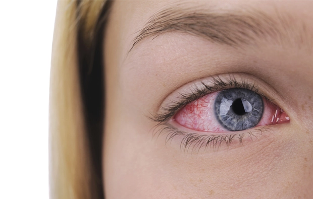 Consejos para evitar los ojos rojos