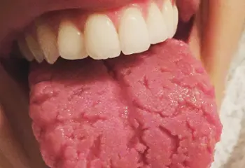 Lengua geográfica: síntomas, causas y tratamiento