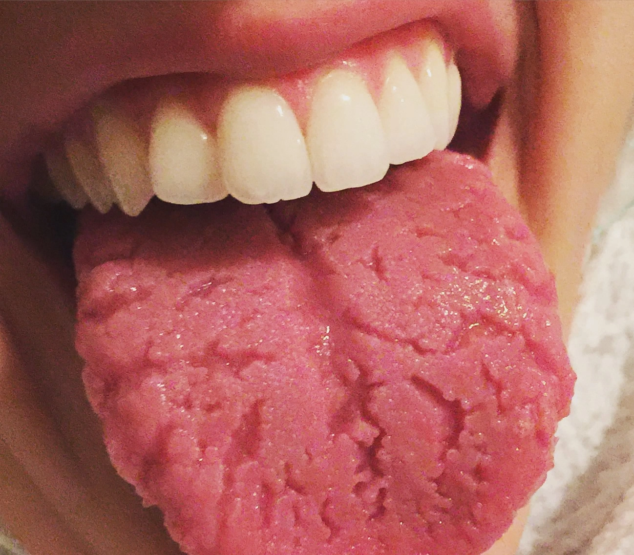 Lengua geográfica: síntomas, causas y tratamiento