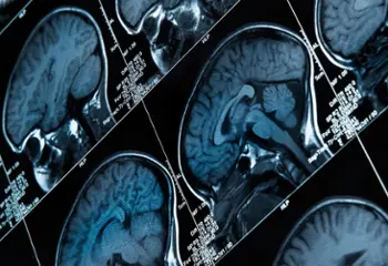 ¿Qué sabes de la epilepsia?