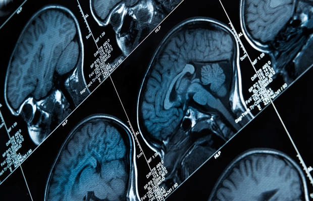 ¿Qué sabes de la epilepsia?
