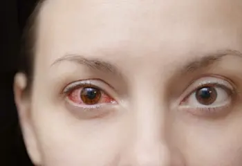 ¿Qué es la queratitis ocular?