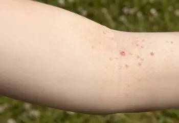 ¿Qué sabes del molusco contagioso?