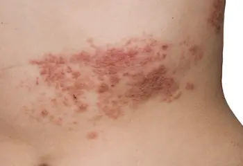 El herpes zóster acecha