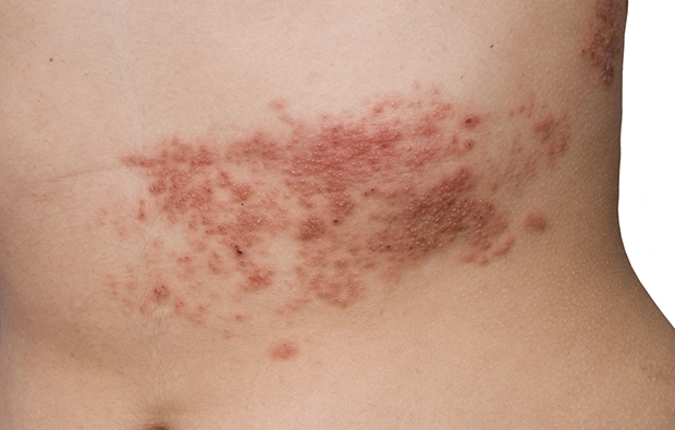 El herpes zóster acecha