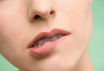¿Sabes lo que es la queilitis angular?