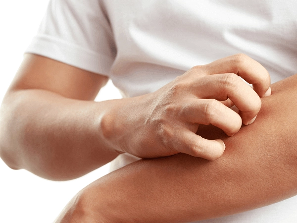 ¿Sabes qué es la mastocitosis? Cómo evitarla