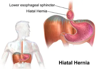 Hernia de hiato