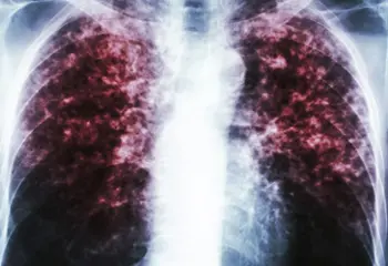 Semana Europea del Cáncer de Pulmón: prevención y diagnóstico precoz
