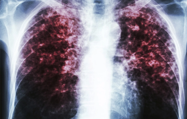 Semana Europea del Cáncer de Pulmón: prevención y diagnóstico precoz