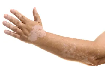 Vitíligo: las manchas de la piel que afectan el ánimo