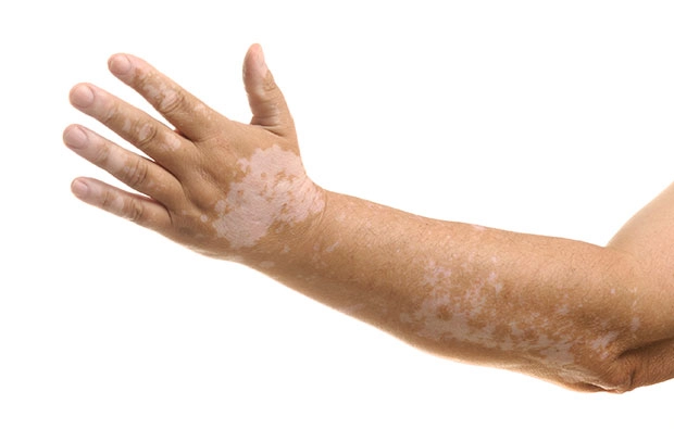 Vitíligo: las manchas de la piel que afectan el ánimo
