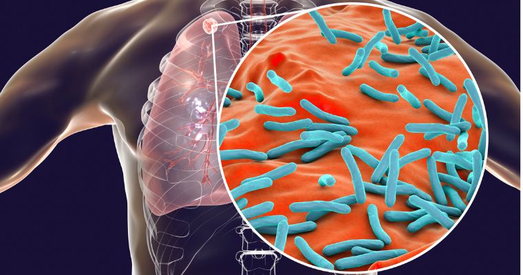 Prevención de la tuberculosis: el papel del farmacéutico