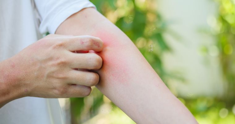 Por qué cada vez hay más alergias en verano 